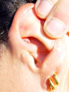 Caesar's botfly larva scar in his ear.